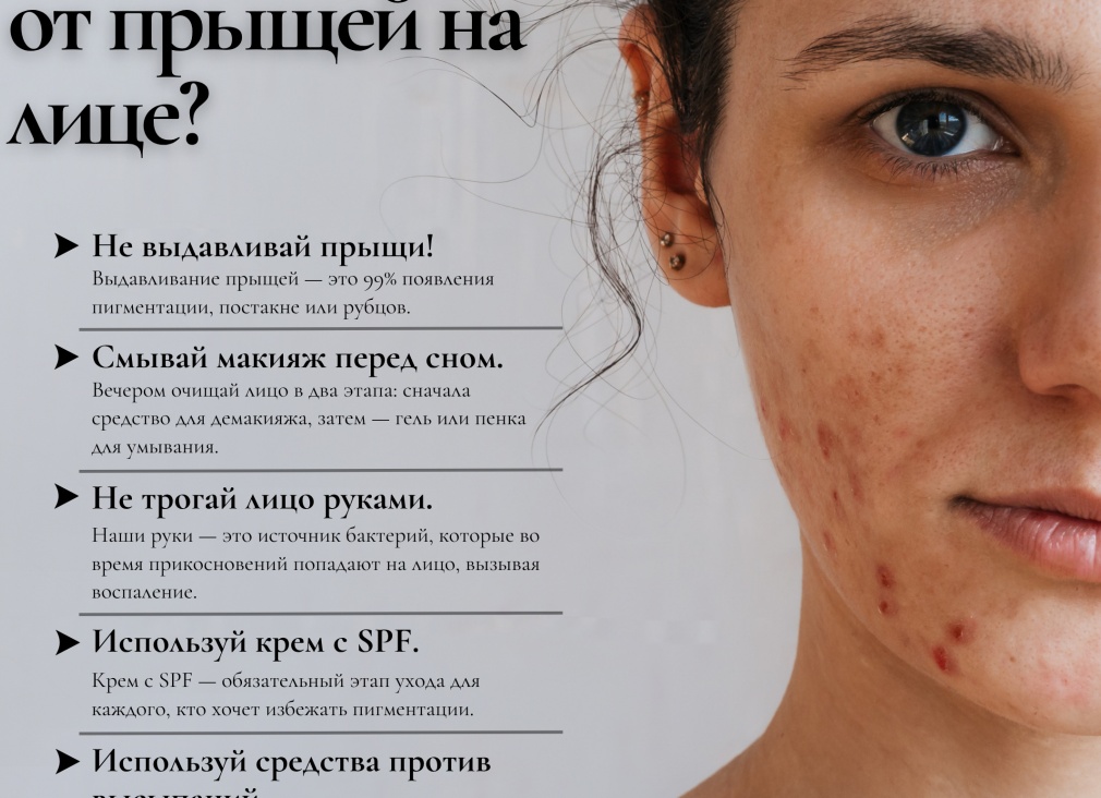 Как быстро избавиться от прыщей на лице за 1 день в домашних условиях